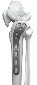 Пластина опорная для латерального	Support stable angle plate мыщелка с у/с 16,0х4,5 мм	for the lateral condyle 16,0х4,5 mm