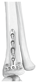 Пластина для лучевой кости (ЛТм) LCP Plate Radial Bone (LTM) 6,5x2,0 mm с у/с 6,5х2,0 мм