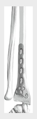 Пластина для лучевой кости с у/с 10,0х2,8 мм	LCP Plate Radial Bone 10,0х2,8 mm