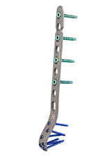 Пластины Vortex Distal Humerus