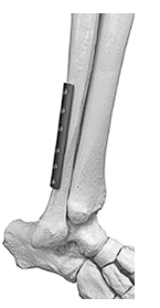 Пластина трубчатая 1/3 с у/с 10,0x1,5 мм	LCP One-third Tubular Plate 10,0x1,5 mm